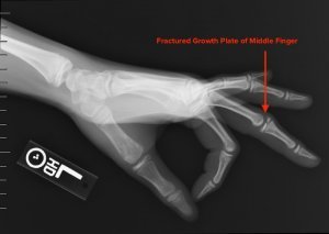 Youth Finger Injuries Solutions | Onsight Sports Med